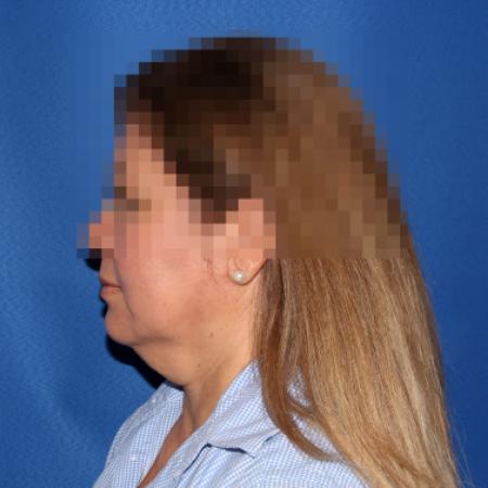 Before image 3 Case #107411 - Facelift/Necklift