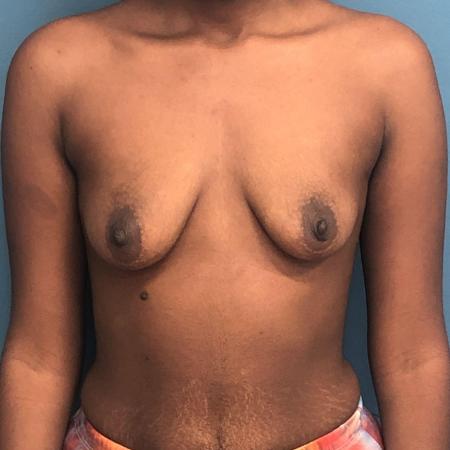 Before image 1 Case #107386 - Breast Augmentation with Mastopexy