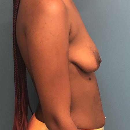 Before image 2 Case #107386 - Breast Augmentation with Mastopexy