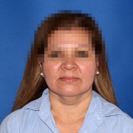 Before image 1 Case #107411 - Facelift/Necklift