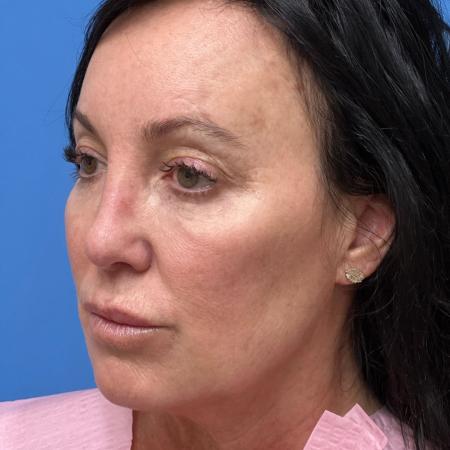 After image 2 Case #107211 - 52 year old - Open Rhinoplasty - 3 months post op