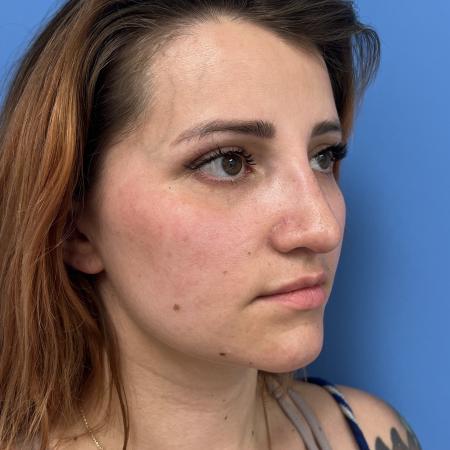 After image 2 Case #106676 - 29 year old - Open Rhinoplasty - 1 month post op