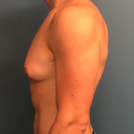 Before image 2 Case #107356 - Gynecomastia