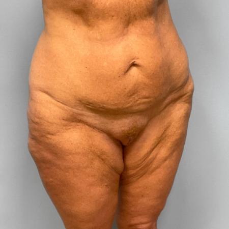 Before image 2 Case #107281 - Tummy Tuck and Medial Thigh Lift