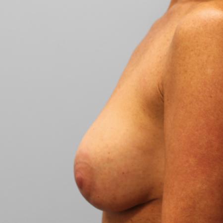 Before image 3 Case #107286 - Breast Augmentation