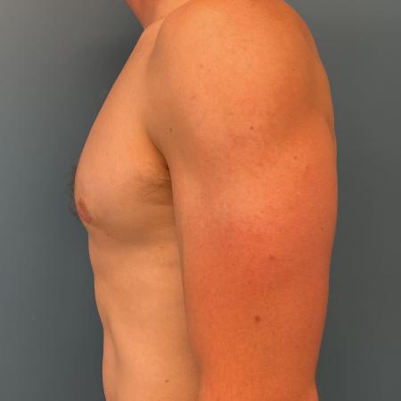 After image 2 Case #107356 - Gynecomastia