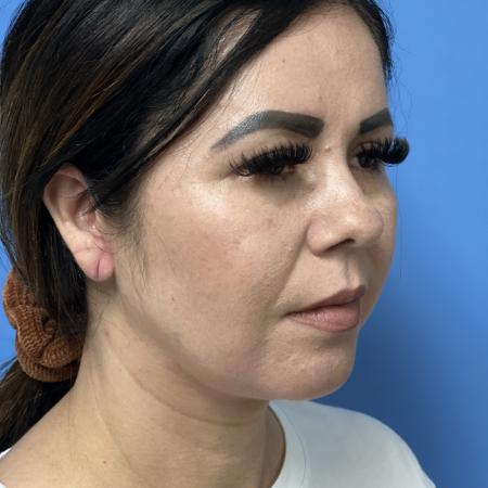 Before image 2 Case #107291 - 43 year old  --  Facelift  -  3 months post-op