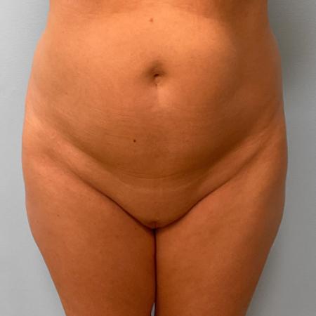 Before Case #107226 - Mommy Makeover
