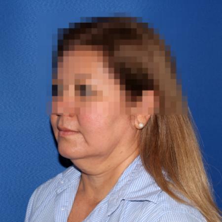 Before image 2 Case #107411 - Facelift/Necklift