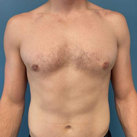 After image 1 Case #107356 - Gynecomastia