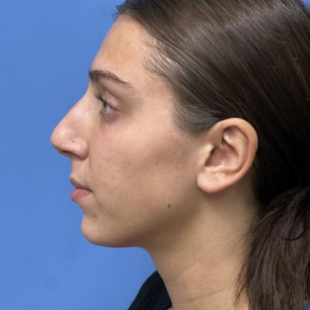 Before image 3 Case #107301 - Rhinoplasty