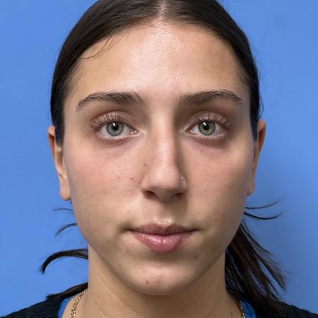 Before image 1 Case #107301 - Rhinoplasty