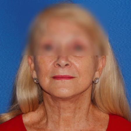 After image 1 Case #107381 - Secondary Facelift