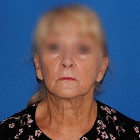 Before image 1 Case #107381 - Secondary Facelift
