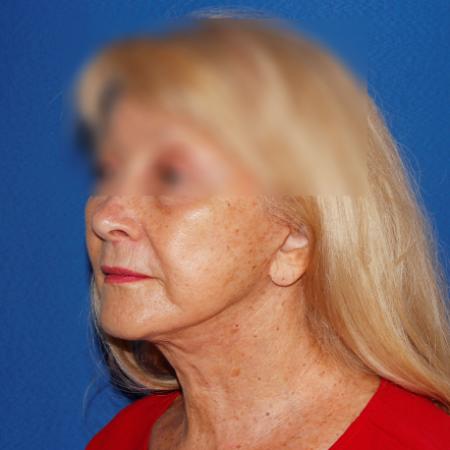After image 2 Case #107381 - Secondary Facelift