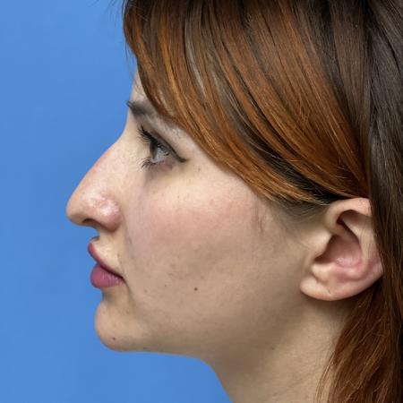 Before image 3 Case #106676 - 29 year old - Open Rhinoplasty - 1 month post op