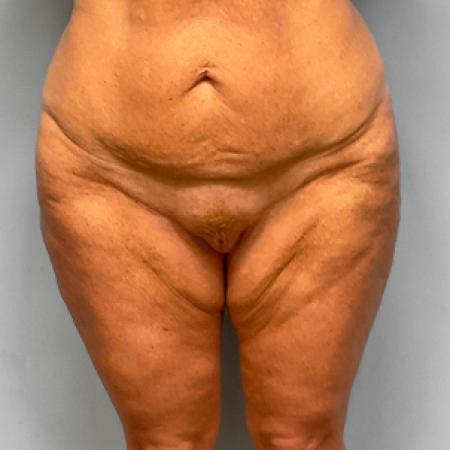 Before image 1 Case #107281 - Tummy Tuck and Medial Thigh Lift