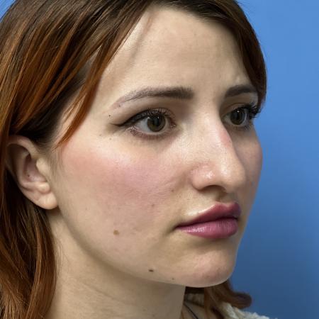 Before image 2 Case #106676 - 29 year old - Open Rhinoplasty - 1 month post op