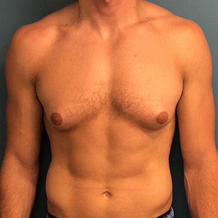 Before image 1 Case #107356 - Gynecomastia