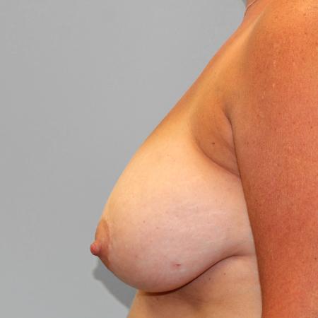 Before image 3 Case #107241 - Breast Reconstruction