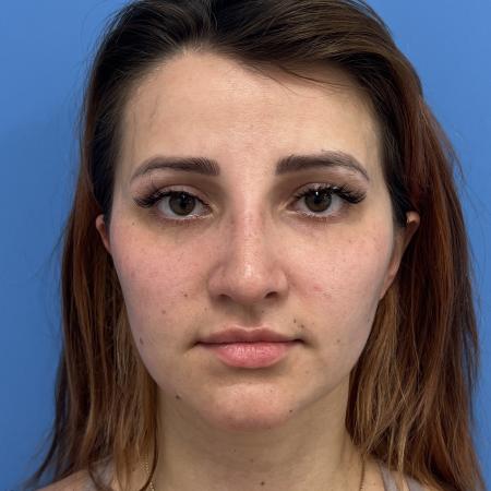 After image 1 Case #106676 - 29 year old - Open Rhinoplasty - 1 month post op