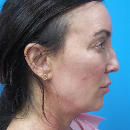 Before image 3 Case #107211 - 52 year old - Open Rhinoplasty - 3 months post op