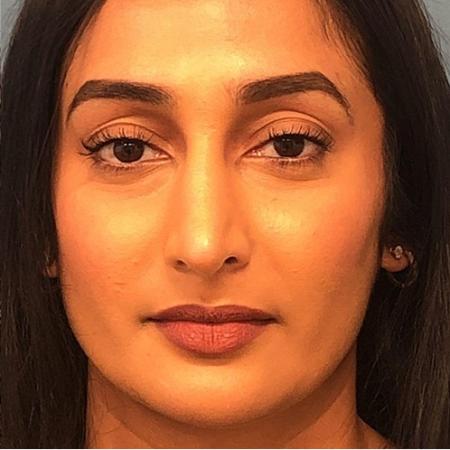 After image 1 Case #107366 - Rhinoplasty