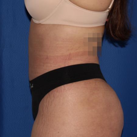 After image 3 Case #107296 - Tummy tuck and liposuction flanks