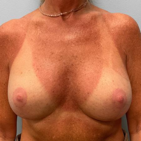 After image 1 Case #107286 - Breast Augmentation