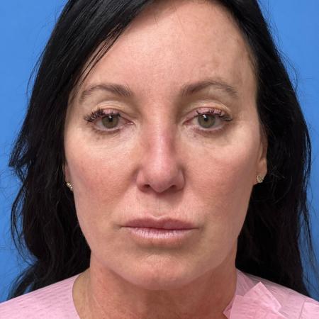 After image 1 Case #107211 - 52 year old - Open Rhinoplasty - 3 months post op