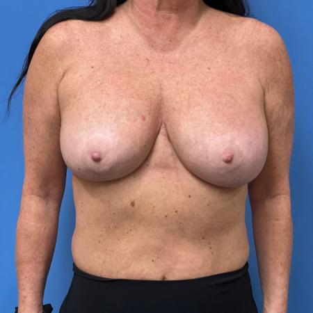 After image 1 Case #107216 - 52 Years Old - Silicone Gel Breast Augmentation 