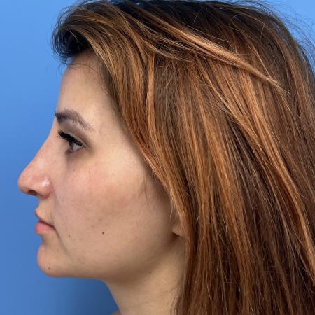 After image 3 Case #106676 - 29 year old - Open Rhinoplasty - 1 month post op