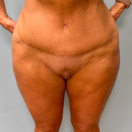 After image 1 Case #107281 - Tummy Tuck and Medial Thigh Lift