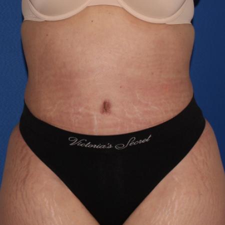 After image 1 Case #107296 - Tummy tuck and liposuction flanks