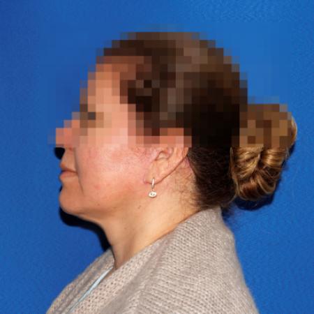 After image 3 Case #107411 - Facelift/Necklift