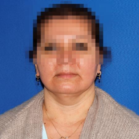 After image 1 Case #107411 - Facelift/Necklift