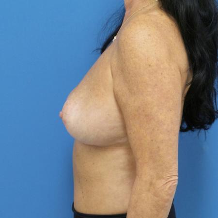 Before image 3 Case #107216 - 52 Years Old - Silicone Gel Breast Augmentation 