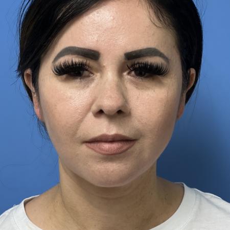 Before image 1 Case #107291 - 43 year old  --  Facelift  -  3 months post-op