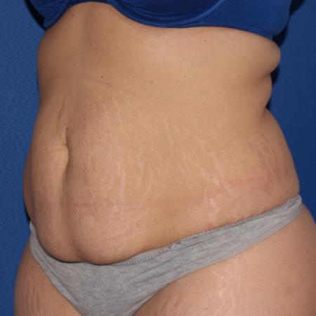 Before image 2 Case #107296 - Tummy tuck and liposuction flanks