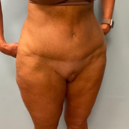 After image 2 Case #107281 - Tummy Tuck and Medial Thigh Lift