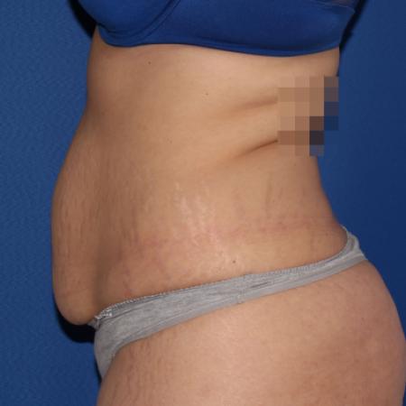 Before image 3 Case #107296 - Tummy tuck and liposuction flanks