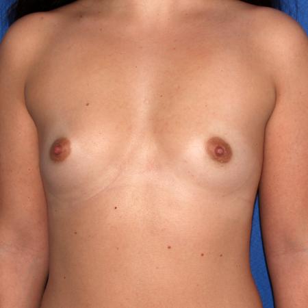 Before Case #106811 - Breast Augmentation