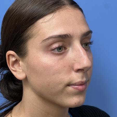 Before image 2 Case #107301 - Rhinoplasty