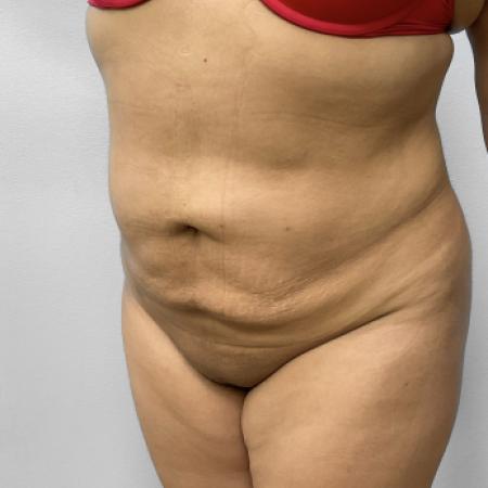 After Case #108131 - Lipo & BBL