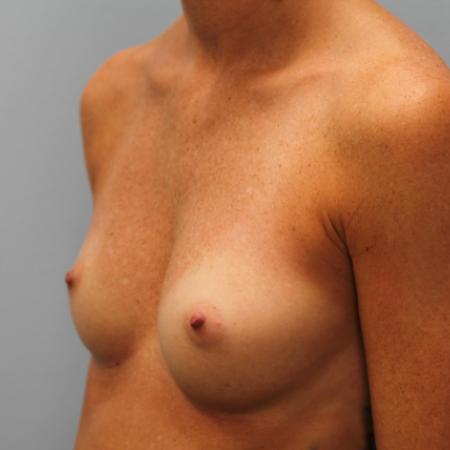 Before image 2 Case #107951 - Breast Augmentation
