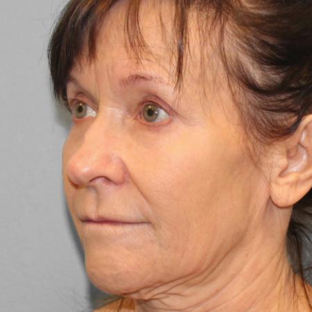 Before image 2 Case #108286 - Facelift & Blepharoplasty