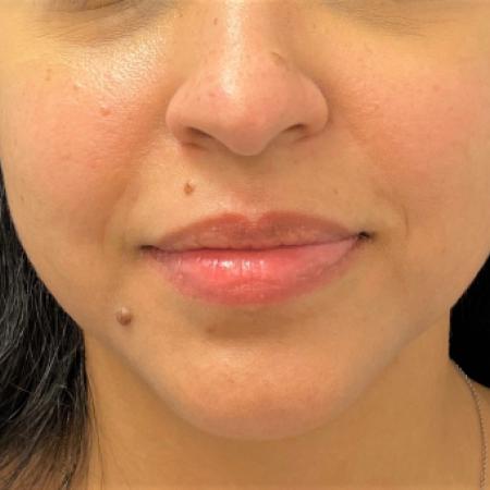 Before image 1 Case #107936 - Cosmetic Mole Removal (Nose, Upper Lip & Chin)