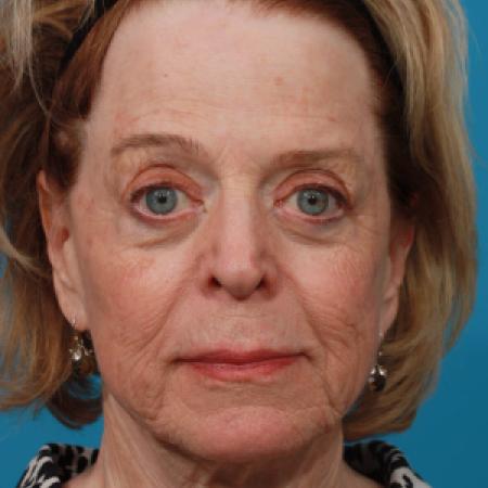 Before image 1 Case #108366 - Full Face Erbium Resurfacing