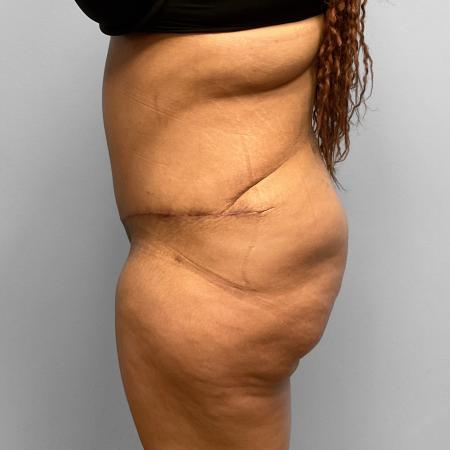 After image 3 Case #108136 - Tummy Tuck & BBL