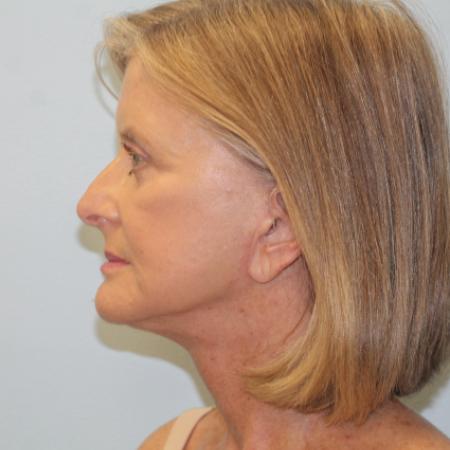 After image 3 Case #108171 - Facelift, Browlift, & Blepharoplasty